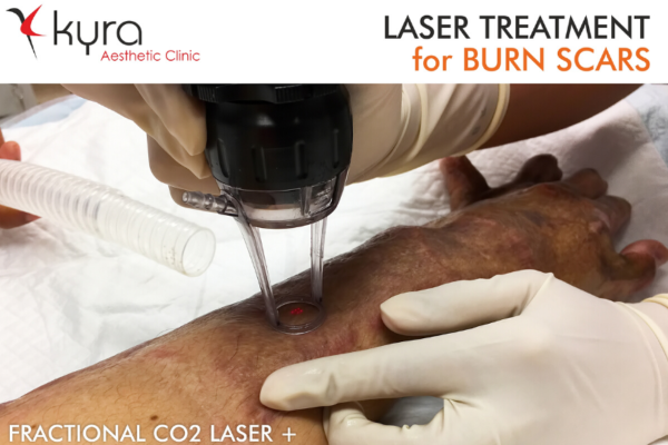 Laser for Burn Scar