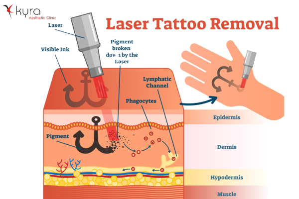 Laser Tattoo Removal