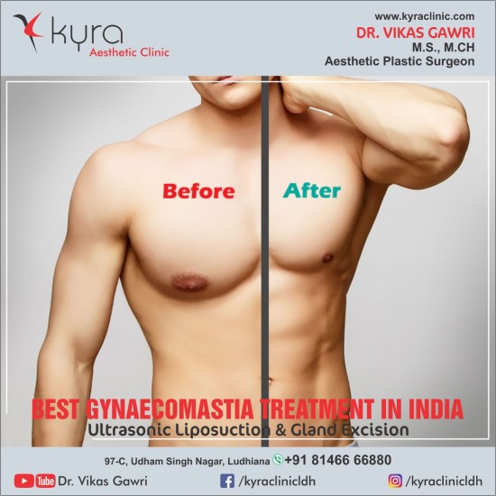 Treatment Options For Gynecomastia In Ludhiana 8085