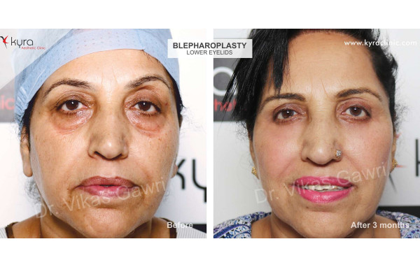  Blepharoplasty or Eyelid Surgery Case 1 							 