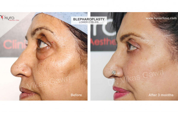  Blepharoplasty or Eyelid Surgery Case 1 							 