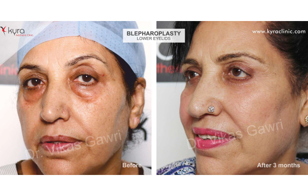  Blepharoplasty or Eyelid Surgery Case 1 							 