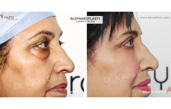  Blepharoplasty or Eyelid Surgery Case 1 							 