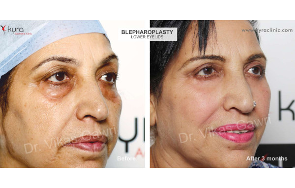  Blepharoplasty or Eyelid Surgery Case 1 							 