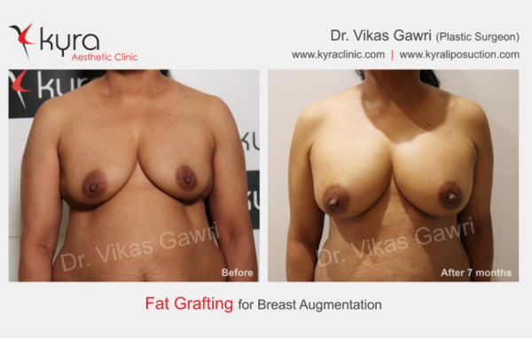  Fat Transfer to Breast Case 1 							 