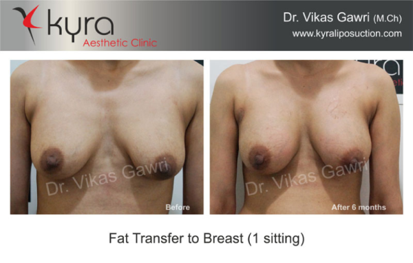  Fat Transfer to Breast Case 4 							 
