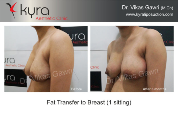  Fat Transfer to Breast Case 4 							 