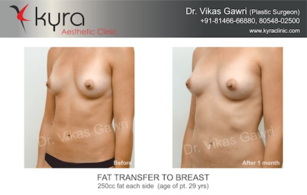  Fat Transfer to Breast Case 5 							 