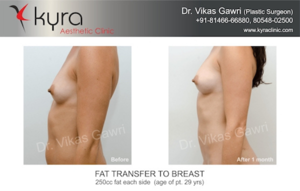  Fat Transfer to Breast Case 5 							 